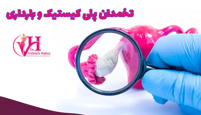 تخمدان پلی کیستیک و بارداری