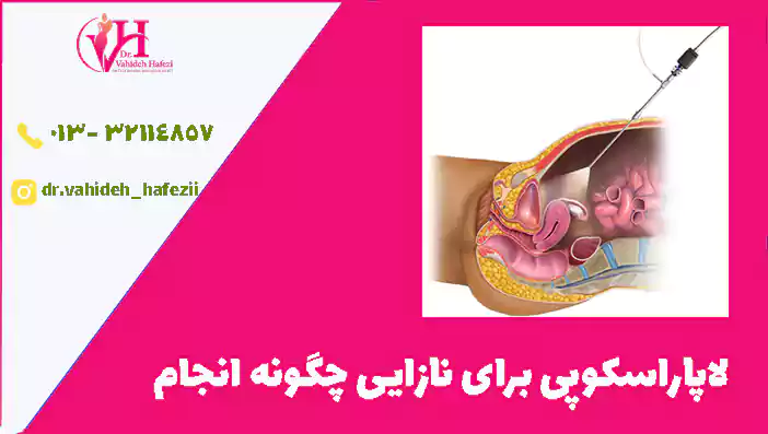 لاپاراسکوپی برای نازایی چگونه انجام میشود؟