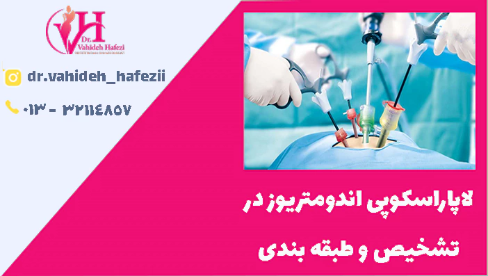 لاپاراسکوپی اندومتریوز در تشخیص و طبقه بندی