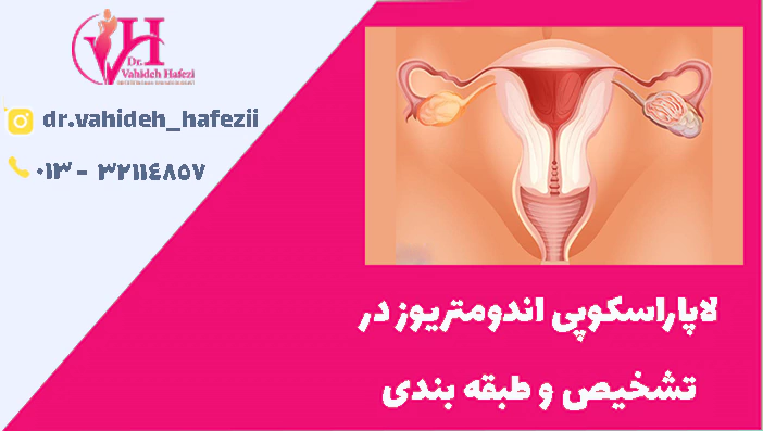 لاپاراسکوپی اندومتریوز در تشخیص و طبقه بندی