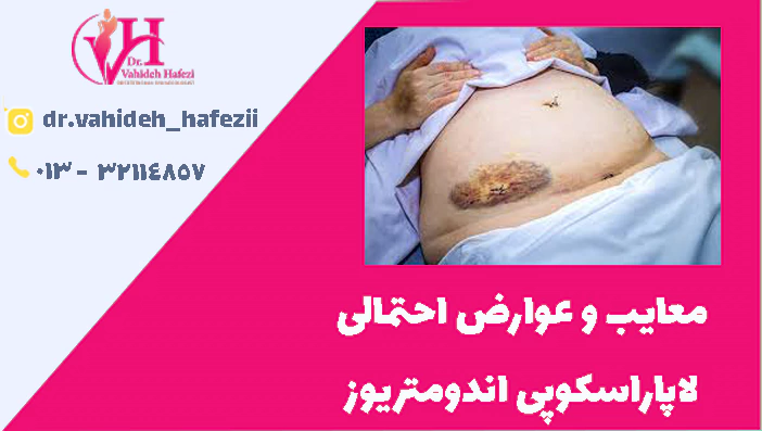 معایب و عوارض احتمالی لاپاراسکوپی اندومتریوز