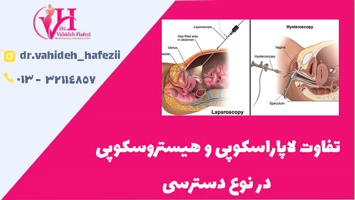 تفاوت لاپاراسکوپی و هیستروسکوپی
 در نوع دسترسی 