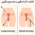 تفاوت لاپاراسکوپی و هیستروسکوپی