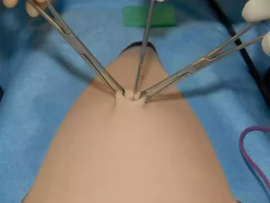 عوارض جراحی لاپاراسکوپی رحم چیست