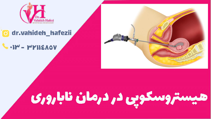 هیستروسکوپی در درمان ناباروری