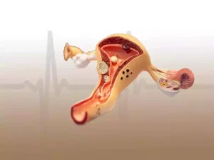 هزینه عمل هیستروسکوپی