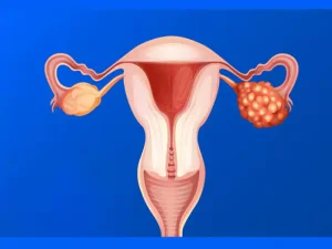 راهکارهای موثر و سریع برای درمان کیست تخمدان