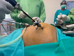 عمل کیست تخمدان