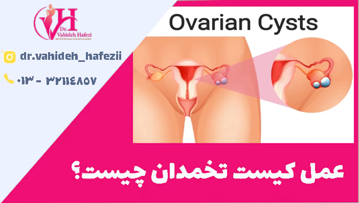 عمل کیست تخمدان چیست