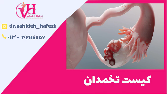 کیست تخمدان