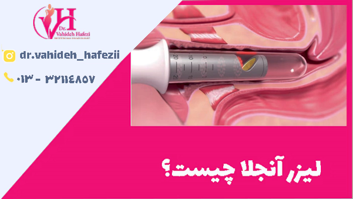 لیزر آنجلا چیست؟